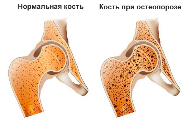 При остеопорозе в кости появляется большое количество мелких пор, доля твердых тканей уменьшается, а с ней снижается и прочность сустава.